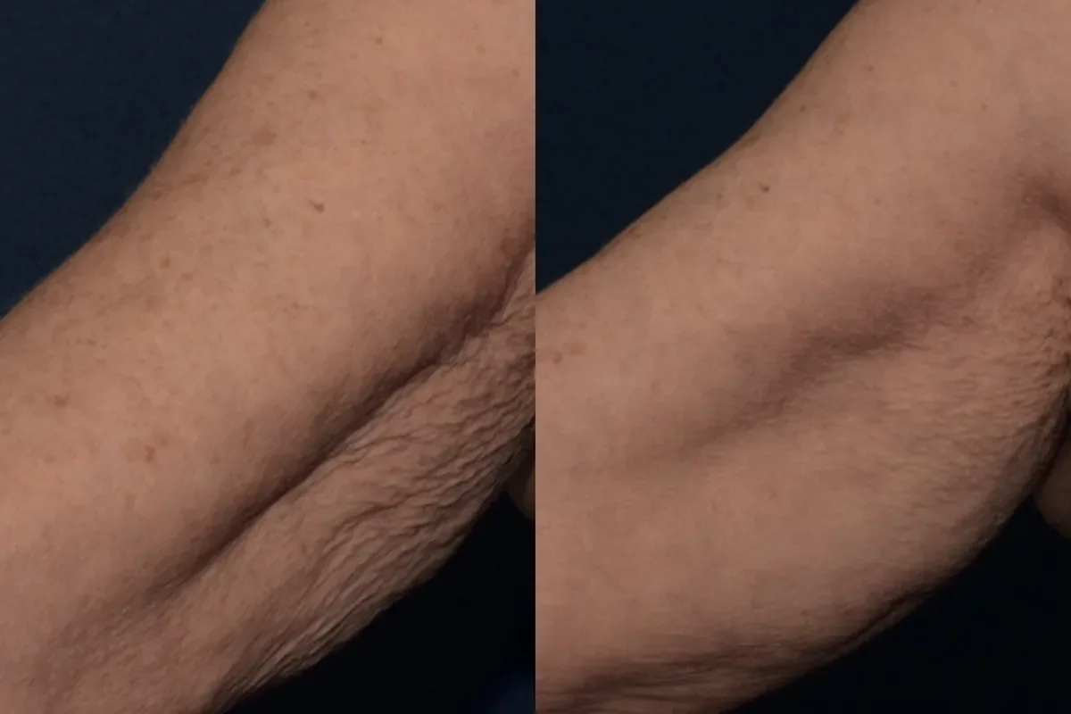 Voor en na: een strakkere huid op de arm